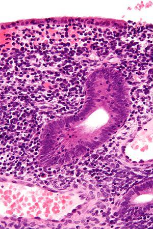 Endometriosis drug treatment