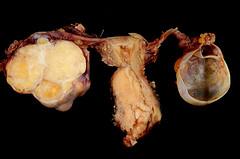 Endometriosis following hysterectomy