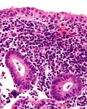 Endometriosis symptoms and signs