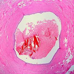 Endometriosis treatment for infertility