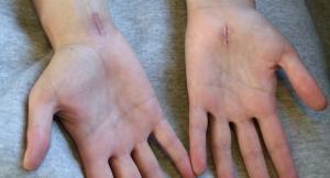 Endoscopic carpal tunnel surgery