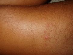 Epidermolysis bullosa complications