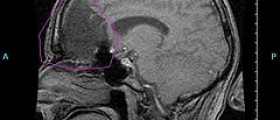 Epilepsy and brain surgery