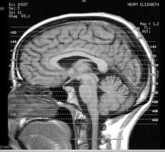 Epilepsy prognosis facts