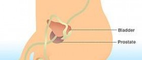 Erectile dysfunction after prostatectomy
