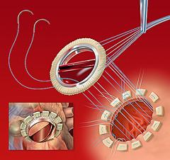 Erectile dysfunction and heart disease
