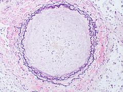 Erectile dysfunction and multiple sclerosis