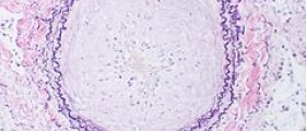 Erectile dysfunction and multiple sclerosis