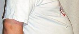 Erectile dysfunction and obesity
