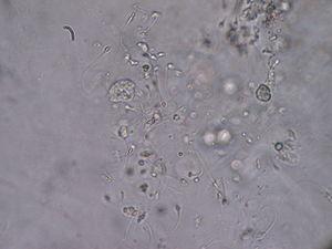 Erectile dysfunction - Low sperm count