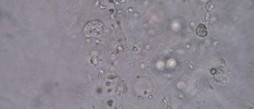 Erectile dysfunction - Low sperm count