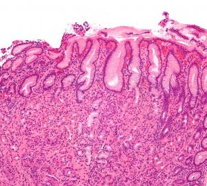 Erosive gastritis facts