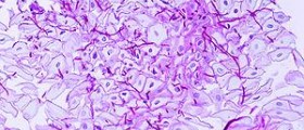 Esophageal cancer age