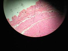 Esophageal cancer and long term survival
