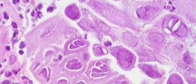 Esophageal cancer barium test