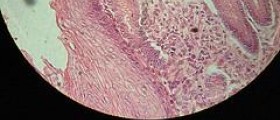 Esophageal cancer diagnosis