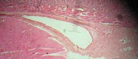 Esophageal cancer final stages