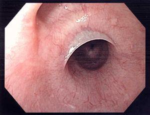 Esophageal cancer first signs