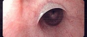 Esophageal cancer first signs