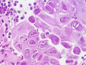 Esophageal cancer first symptoms