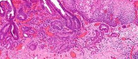 Esophageal cancer greatest risk