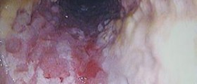 Esophageal cancer growth rate