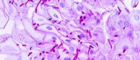 Esophageal cancer prognosis after surgery
