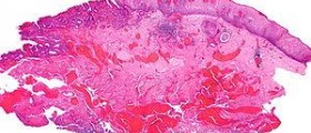 Esophageal cancer surgery recovery