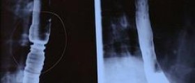 Esophageal cancer surgery side effects