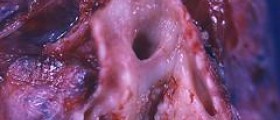 Esophageal cancer types