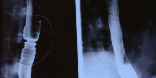 Esophageal spasm: Causes & Risk factors