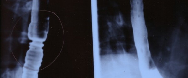 Twisted Esophagus: Esophageal Spasm | Ear, Nose, Throat, and Dental