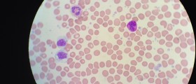 Essential Thrombocytosis