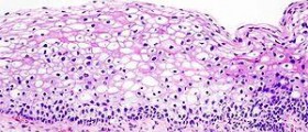 Every woman should know these cancer symptoms!