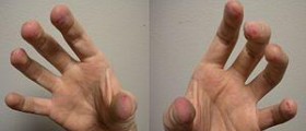Exercise for people with arthritis in hands