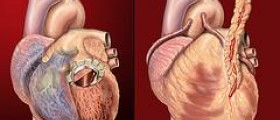 Exercise for people with heart problems