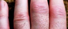 Exercise for people with rheumatoid arthritis