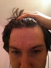 Exfoliator for acne prone skin