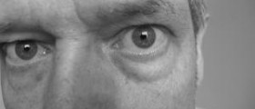 Eye bag removal procedure