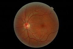 Eye disease and herpes