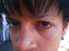 Eye disease conjunctivitis