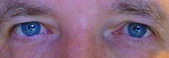 Eye disease degeneration