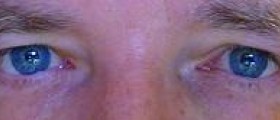Eye disease degeneration