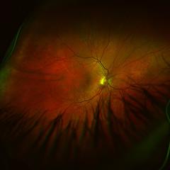 Eye disease from fungal infection