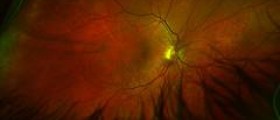 Eye disease from fungal infection