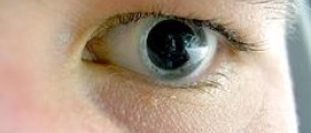 Eye disease keratoconus