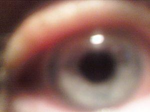 Eye disease - Loss of vision