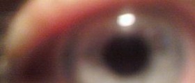 Eye disease - Loss of vision