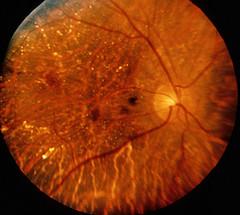 Eye disease - Neuritis