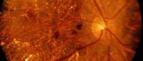 Eye disease - Neuritis